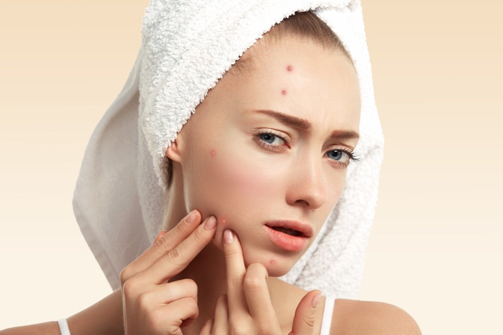 The Best Treatments for Acne-Prone Skin