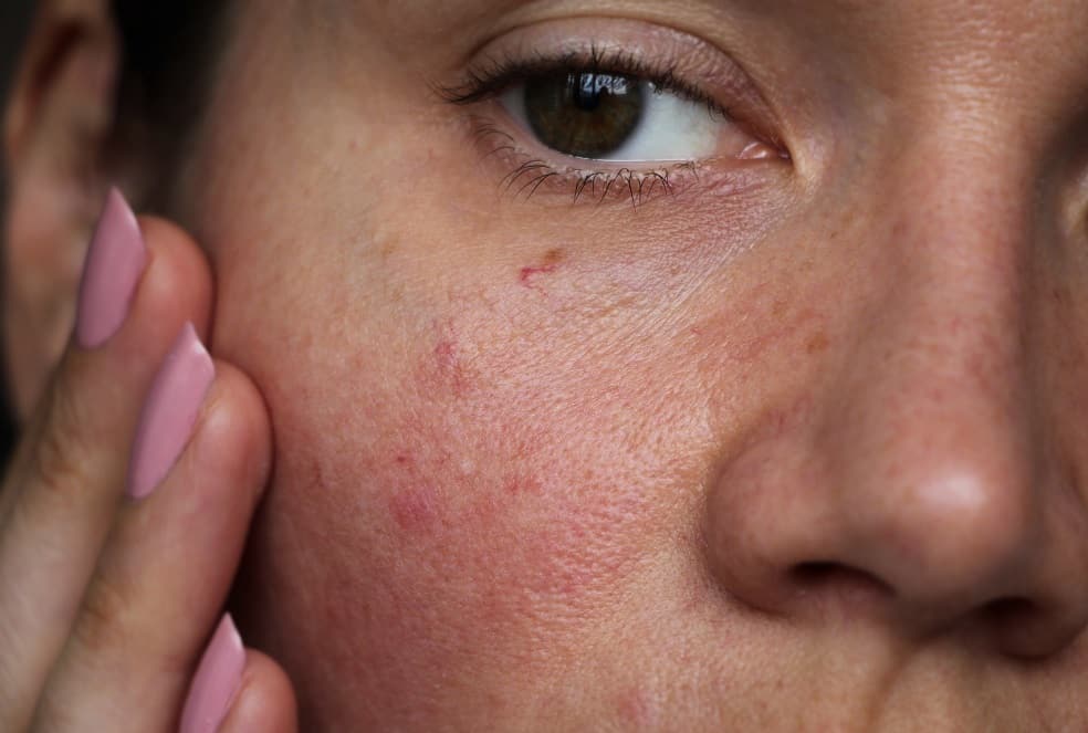 Tips to Combat Sensitive Skin and Get The Healthy Skin